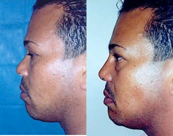 Man treated with African American Rhinoplasty - Nasal tip and nostrils narrowed naturally with rhinoplasty