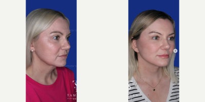 45-54 year old woman treated with Brow Lift, Eyelid Surgery, Revision Rhinoplasty, Facelift, Neck Lift, Mini Facelift, Buccal Fa - 45-54 year old woman treated with Brow Lift, Eyelid Surgery, Revision Rhinoplasty, Facelift, Neck Lift, Mini Facelift, Buccal Fat Removal