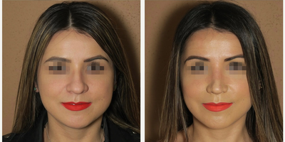 Woman treated with Rhinoplasty - Woman treated with Rhinoplasty