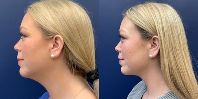 25-34 year old woman treated with Chin Liposuction - 25-34 year old woman treated with Chin Liposuction