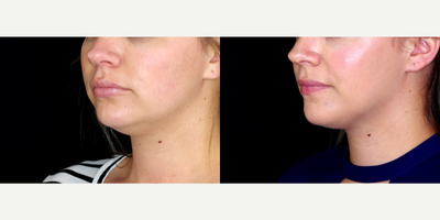 29 year old woman treated with Kybella - 29 year old woman treated with 4 vials of Kybella to submental neck. Photos depict before and 2 months after treatment.
