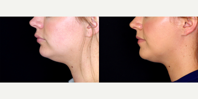 29 year old woman treated with Kybella - 29 year old woman treated with 4 vials of Kybella to submental neck. Photos depict before and 2 months after treatment.