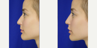 25-34 year old woman treated with Non Surgical Nose Job - 25-34 year old woman treated with Non Surgical Nose Job by Dr. Weiss in Metairie