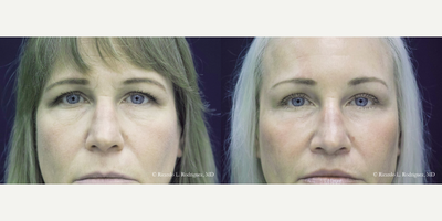 Brow Lift - 45-54 year old woman treated with Brow Lift