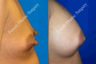 Nipple-areola repair - 	This patient was interested in getting breast implants as well as nipple reduction surgery. She was not happy with the size and shape of her breasts and she did not like how large and protruding her nipples were. Patient is 6 months post op surgery.