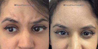 25-34 year old woman treated with Jeuveau - Jeuveau, a cosmetic botulinum toxin similar to Botox, works faster. A 36-year-old patient noticed relaxation within 3 hours, with full effect by day two, compared to Botox, which typically starts working on days 2-3 and peaks at two weeks. While results vary, Jeuveau often acts quicker than Botox.