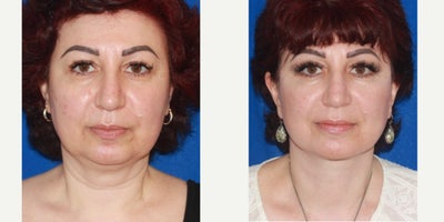 55-64 year old woman treated with Deep Plane Facelift - The patient underwent a deep plane face and neck lift, effectively addressing skin laxity, fullness beneath the chin and cheeks, and jowling, resulting in a refreshed, naturally rejuvenated appearance