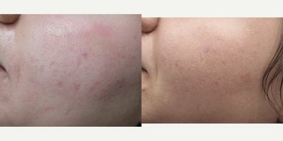 18-24 year old woman treated with Intracel for Acne Scarring - Acne scarring on the cheeks was prominent and unresponsive other treatments. After undergoing three treatments of Intracel microneedling with radiofrequency, she noticed a marked improvement in the appearance of her acne scarring.&nbsp;