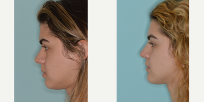 18-24 year old woman treated with Rhinoplasty - Before and after rhinoplasty for a Hispanic female with concerns about the width of her bridge and tip. Refinements included tip and bridge support with ear cartilage, avoiding the use of implants in the nose.