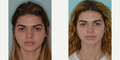 18-24 year old woman treated with Rhinoplasty - Before and after rhinoplasty for a Hispanic female with concerns about the width of her bridge and tip. Refinements included tip and bridge support with ear cartilage, avoiding the use of implants in the nose.