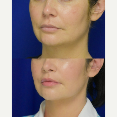 35-44 year old woman treated with Lip Lift - 35-44 year old woman treated with Lip Lift