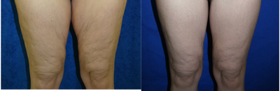 Crescent Thigh Lift  - This is a 36 year old female who weighed 264 pounds. She had RNY gastric bypass and lost 110 pounds. She was not happy with her inner thighs. She did not want a long incision so she underwent a crescent medial thigh lift.