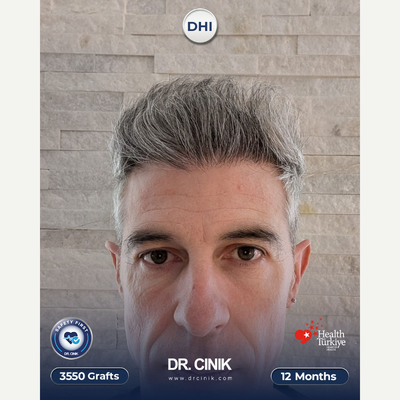 45-54 year old man treated with Hair Transplant, DHI Hair Transplant - 3550 grafts, 12 months DHI hair transplant