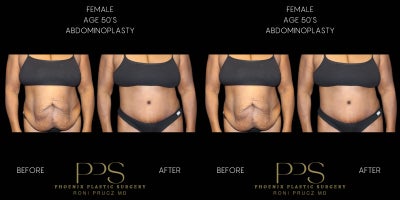 55-64 year old woman treated with Tummy Tuck, Diastasis Recti Repair - 55 year old female, had Abdominoplasty with Diastasis Recti  Repair