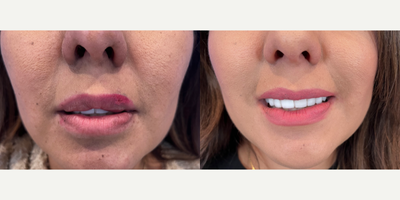 35-44 year old woman treated with Silicone Injections  - Foreign fillers in the body of the lips can undermine the natural appearance of the upper lip, especially when patients have Juvederm or Restylane. This young patient underwent filler removal of an unknown substance on the upper lip. This filler may be fake Juvederm, Restylane, silicone, or bellafill/artefill/aquamid/pmma.
