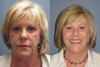 61 year old Blue Peel and Lite Lift  - 	A Blue Peel followed this 61 y/o Lite Lift adding to the skins more youthful appearance helping with skin tone and improved texture.