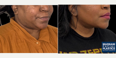 45-54 year old woman treated with Buccal Fat Removal, Chin Liposuction - 52-year-old female who underwent Buccal fat reduction  and chin and neck Lipo sculpting