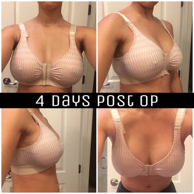 28FF/30F 5'3, 115 Lbs, sore, saggy Breasts - Review - RealSelf