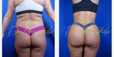 Hourglass Butt Augmentation - Here's a patient who underwent the hourglass butt augmentation procedure. This method clearly improved her really small buttocks into bigger and well projected butt.