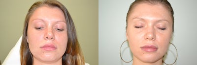 Lip Implant - 
	This patient has always desired to have fuller lips. She has been doing lip injections with Juvederm for a few years prior to her decision to try a permanent lip enlargement with a lip implant. A medium size Perma lip implant was placed in the office under local anesthesia to the upper and lower lips which provided the patient with a quick and permanent solution.
