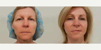 Woman treated with Facelift - Woman treated with Facelift as well as Deep Laser Resurfacing and Endoscopic Eye Lift.