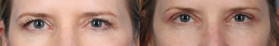 45-54 year old woman treated with Plasma Pen on her Upper Eyelids - Patient underwent an upper eye lift with the Plasma Pen.