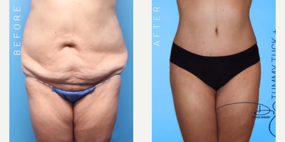 Woman treated with Butt Lift - Woman treated with Natural Butt Lift and Tummy Tuck