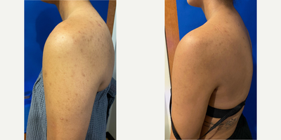 Woman treated with Chemical Peel, PCA Skin Peel - Woman treated with Chemical Peel, PCA Skin Peel