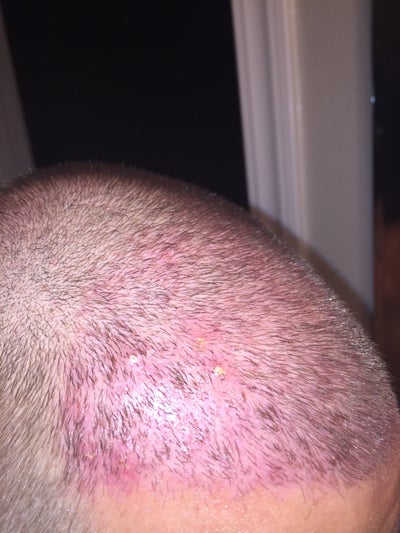 Will folliculitis 8 days post hair transplant effect graft growth ...