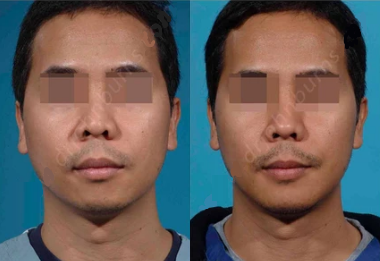Man treated with Chin Surgery - Man treated with Chin Surgery