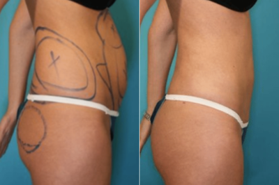 35-44 year old woman treated with Body-Jet - Female patient underwent liposuction of the abdomen and flanks area.