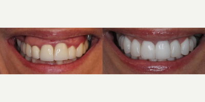 Woman treated with Tooth Repair - Woman treated with Tooth Repair through use of veneers (20 porcelain restorations) crowns, bridges and gum lift for full mouth rehabilitation.