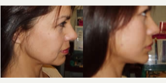 Thread Lift - Woman treated with Thread Lift