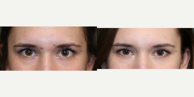 Scar Treatment After Mole Removal - Mole removal scars treated with laser and fat transfer.