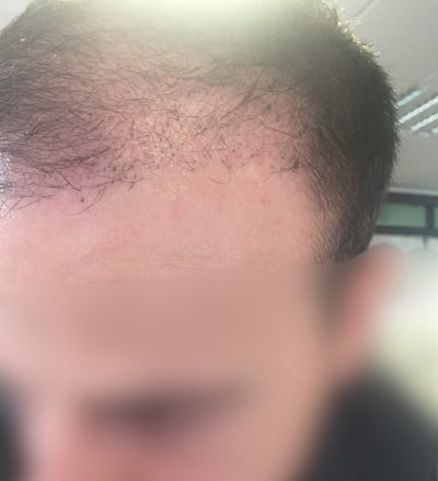 Hair Of Istanbul Hair Transplant On 16th April 2018 Review