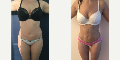 35-44 year old woman treated with Liposuction - Amazing post op results in this 36 year old patient from San Francisco, California two months after 360 liposuction and Brazilian butt lift with Premium Care. Surgical time was minimized using two plastic surgeons, and she spent 10 days after surgery recovering in Cartagena at our five star Recovery Suites. Her figure looks amazing!
