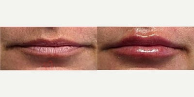 45-54 year old woman treated with Juvederm, Restylane, Lip Fillers, Restylane Kysse, Volbella - Lip augmentation with hyaluronic acid filler (Juvederm, Vollure, Volbella, Voluma, Restylane or Belotero) for balanced natural look & pout