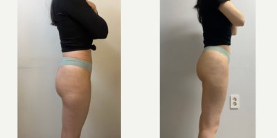 35-44 year old woman treated with Nonsurgical Butt Lift, Liposuction - Chief Complain: hip hollow and massive saddlebags,old-looking shapeTreatment Plan: saddlebags liposuction (thigh) liposuction & hip and buttock fat transfer Outcome: 1000cc pure fat extracted (per side), natural smooth thight shape 700cc fat was injected to hip & hip dips. Visually longer legs, apple hips and rounded butt shape