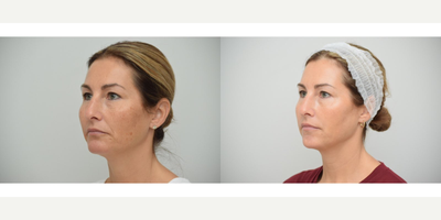 35-44 year old woman treated with GentleLase, Dysport, Revanesse, RHA Collection Fillers - Combination aesthetic treatment (Precise Aesthetic Balance) of Alex Gentelase laser for sun spots and skin photodamage to brighten skin tone and Dysport to glabella to relax tension frown lines, aka 11s, and Versa Hyaluronic Acid Filler in smile lines (nasolabial folds and marionettes) to soften wrinkle lines around the mouth.