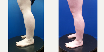 18-24 year old woman treated with Calf Reduction - 24-year-old lady underwent Power & Laser-assisted Liposuction of the Calves, Ankles & Lateral Feet.