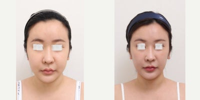 25-34 year old woman treated with AccuLift, Laser Liposuction - 28 Years old female patient Chief Complain: - over injected forehead (fat graft 3 years ago in X clinic) - double chin & overall facial fat Treatment Plan: full face liposuction /forehead reconstruction by liposuctionOutcome: - forehead liposuction pure fat: 20cc- double chin liposuction pure fat: 50- face liposuction pure fat : 124cc (cheek side, front, near ears, zygomatical angle)
