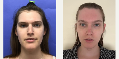 Patient treated with Facial Feminization Surgery, Transgender Facial Feminization Surgery - 25 to 34 year-old female patient is 1 month post-op from Facial Feminization surgery. Her procedures included: Forehead Lift, Hairline Lowering, Orbital Bony Contouring, Septorhinoplasty (closed) with Cartilage Grafts and Weirs, Chin Reduction and Contour, Thyroid Cartilage Shave, Voice Feminization and Fat Augmentation to Lips.