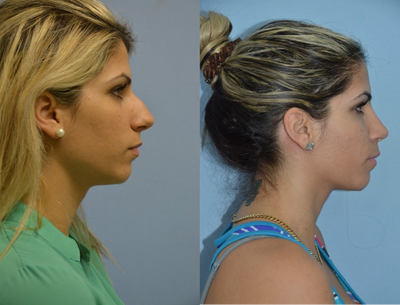 25-34 year old woman treated with Rhinoplasty - 25 year old female 9 months after undergoing a rhinoplasty.