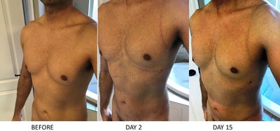 lipo-c reviews Laser lipo is a winner! Korean skinacre Quantity:3 Months Supply The Power of Peptides: