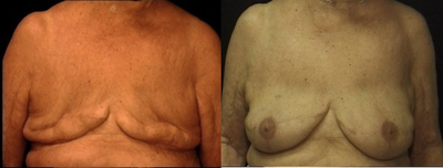 Breast Reconstruction  - 
	Breast Reconstruction
