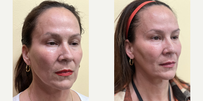 55-64 year old woman treated with Contour Thread Lift - PDO threads stimulate collagen and aims to lift, reshape, and redefine the contour of the face, brows, eyes, jawline, jowls, and cheek areas.