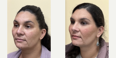 55-64 year old woman treated with Contour Thread Lift - PDO threads stimulate collagen and aims to lift, reshape, and redefine the contour of the face, brows, eyes, jawline, jowls, and cheek areas.