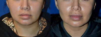 32 year old woman treated with Buccal Fat Removal and Neck Liposuction - 32 year old female with a full lower face and neck.  She was desiring a more sculpted lower face.  She had neck liposuction and buccal fat reduction. Note the more contoured lower face and improved neck profile.