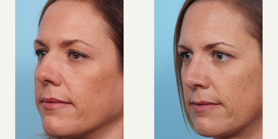 Woman treated with Rhinoplasty - Dr. Balikian preformed an open Rhinoplasty 6 months ago. She was bothered by her large hump and upturned nose. You can notice the hump is gone and upturned nose in a natural position. The swelling will continue to go away in the next six months.