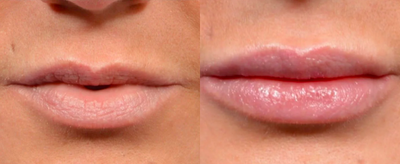 35-44 year old woman treated with Lip Implants - Medium size perma-lip implant